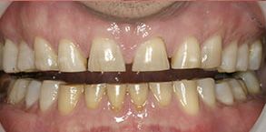 Lynbrook Before and After Teeth Whitening