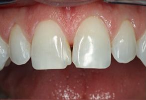 Oceanside Before and After Dental Implants